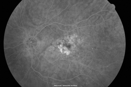 Best Disease for 30 Years - 20/50 Vision both eyes - 61 Year Old Woman
61-year-old woman was diagnosed with Bestâ€™s disease about 30 years ago.  She and her many family members were tested, both at the VA Hospital and then at USF.   OD 20/50, OS 20/50
