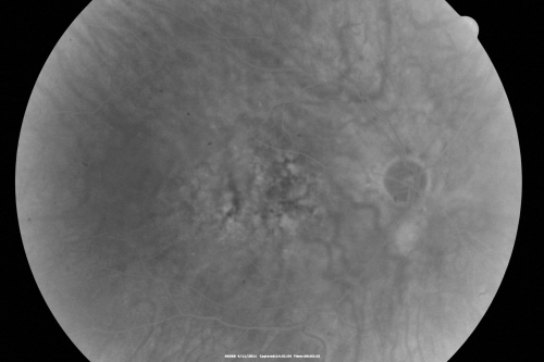 Best Disease for 30 Years - 20/50 Vision both eyes - 61 Year Old Woman
61-year-old woman was diagnosed with Bestâ€™s disease about 30 years ago.  She and her many family members were tested, both at the VA Hospital and then at USF.   OD 20/50, OS 20/50
