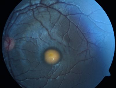 Best Disease, Vitelliform Macular Dystrophy - 6 year old child
VISUAL ACUITY: Vision OD is 20/30, OS is 20/100. 

