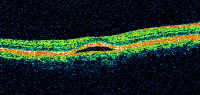 Best Disease, Vitelliform Macular Dystrophy - 6 year old child
VISUAL ACUITY: Vision OD is 20/30, OS is 20/100. 

