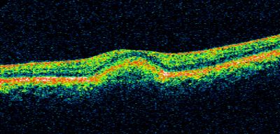 Best Disease, Vitelliform Macular Dystrophy - 6 year old child
VISUAL ACUITY: Vision OD is 20/30, OS is 20/100. 


