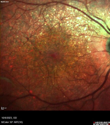 Bietti's Crystalline Dystrophy - CYP4V2 homozygous
58-year-old-female (from Thailand)
Patient had evaluation for LASIK and there was concern that the BCVA was not normal.
PMHx Benign,  Meds: none
VA 20/25 OU
