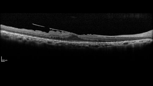Bietti's Crystalline Dystrophy - CYP4V2 homozygous
58-year-old-female (from Thailand)
Patient had evaluation for LASIK and there was concern that the BCVA was not normal.
PMHx Benign,  Meds: none
VA 20/25 OU
