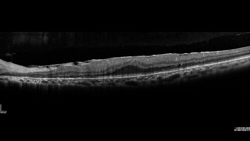 Bietti's Crystalline Dystrophy - CYP4V2 homozygous
58-year-old-female (from Thailand)
Patient had evaluation for LASIK and there was concern that the BCVA was not normal.
PMHx Benign,  Meds: none
VA 20/25 OU

