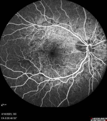 Bietti's Crystalline Dystrophy - CYP4V2 homozygous
58-year-old-female (from Thailand)
Patient had evaluation for LASIK and there was concern that the BCVA was not normal.
PMHx Benign,  Meds: none
VA 20/25 OU

