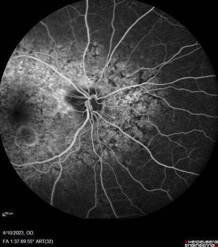 Bietti's Crystalline Dystrophy - CYP4V2 homozygous
58-year-old-female (from Thailand)
Patient had evaluation for LASIK and there was concern that the BCVA was not normal.
PMHx Benign,  Meds: none
VA 20/25 OU
