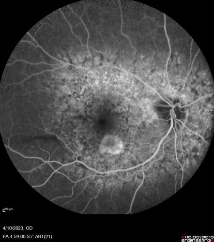 Bietti's Crystalline Dystrophy - CYP4V2 homozygous
58-year-old-female (from Thailand)
Patient had evaluation for LASIK and there was concern that the BCVA was not normal.
PMHx Benign,  Meds: none
VA 20/25 OU
