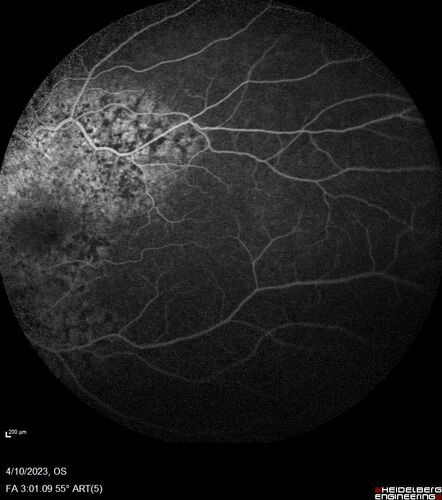 Bietti's Crystalline Dystrophy - CYP4V2 homozygous
58-year-old-female (from Thailand)
Patient had evaluation for LASIK and there was concern that the BCVA was not normal.
PMHx Benign,  Meds: none
VA 20/25 OU
