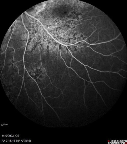 Bietti's Crystalline Dystrophy - CYP4V2 homozygous
58-year-old-female (from Thailand)
Patient had evaluation for LASIK and there was concern that the BCVA was not normal.
PMHx Benign,  Meds: none
VA 20/25 OU
