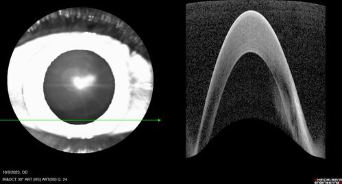 Bietti's Crystalline Dystrophy - CYP4V2 homozygous
58-year-old-female (from Thailand)
Patient had evaluation for LASIK and there was concern that the BCVA was not normal.
PMHx Benign,  Meds: none
VA 20/25 OU

