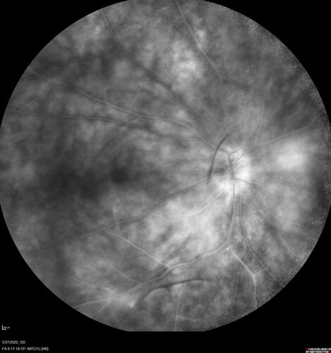 Birdshot chorioretinitis with macular edema - positive HLAA29
67 year old female with 'vitreous hemorrhage' in the right eye for a year.  Extensive uveitis work up done but now with HLA A29.  HLA A29 was positive.  She has not responded to kenalog injections (posterior) and will be started on systemic therapy soon
