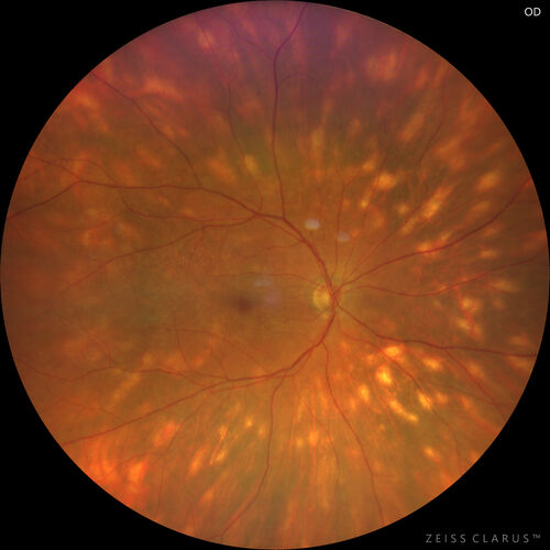 Birdshot Chorioretinitis - Chronic Untreated with Drusen Like Material in Macula
72 year old female with vision changes for years just now diagnosed with Birdshot.
