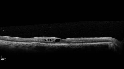 Birdshot Chorioretinitis - Chronic Untreated with Drusen Like Material in Macula
72 year old female with vision changes for years just now diagnosed with Birdshot.
