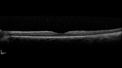 Birdshot Chorioretinitis - Chronic Untreated with Drusen Like Material in Macula
72 year old female with vision changes for years just now diagnosed with Birdshot.

