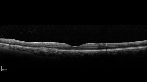 Birdshot Chorioretinitis - Chronic Untreated with Drusen Like Material in Macula
72 year old female with vision changes for years just now diagnosed with Birdshot.
