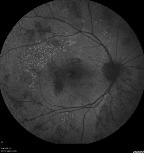 Birdshot Chorioretinitis - Chronic Untreated with Drusen Like Material in Macula
72 year old female with vision changes for years just now diagnosed with Birdshot.
