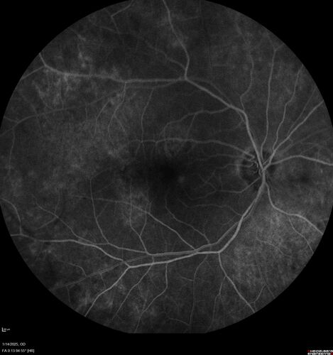 Birdshot Chorioretinitis - Chronic Untreated with Drusen Like Material in Macula
72 year old female with vision changes for years just now diagnosed with Birdshot.
