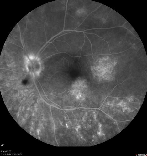 Birdshot Chorioretinitis - Chronic Untreated with Drusen Like Material in Macula
72 year old female with vision changes for years just now diagnosed with Birdshot.
