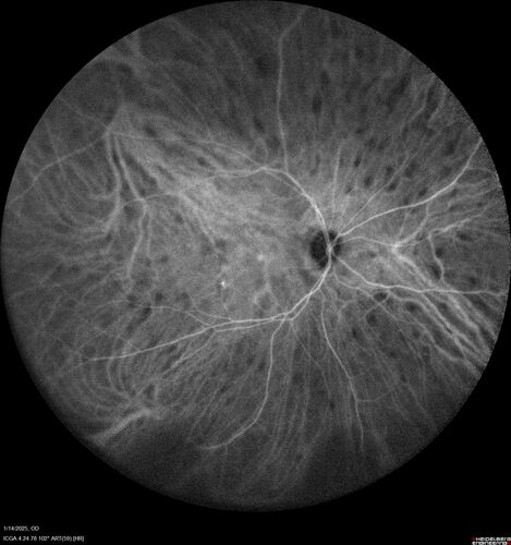 Birdshot Chorioretinitis - Chronic Untreated with Drusen Like Material in Macula
72 year old female with vision changes for years just now diagnosed with Birdshot.

