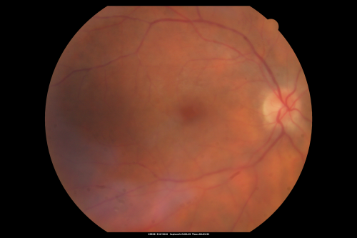 Birdshot Chorioretinitis - Retinal Vasculitis - HLA A29 Positive 
64-year-old woman three or four yearâ€™s fluctuations in her vision.  She mostly notices them in bright light her vision glares out and she has difficulty seeing. PMHx: malaria in 1948 that was treated.  She was told at one point she could possibly have had Familial Mediterranean fever. 

She does intermittently get rashes around her arms.  She has arthritis in her knees and ankles.  
VISUAL ACUITY:  OD 20/40,  OS 20/50 -  HLA - A29 Positive
