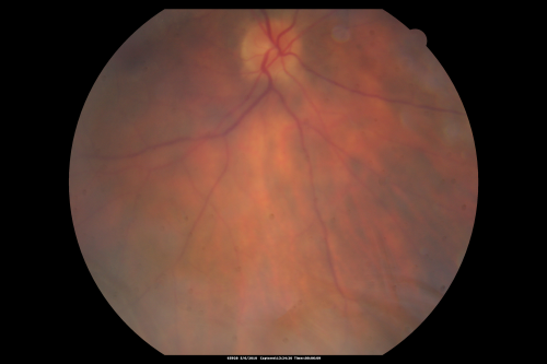 Birdshot Chorioretinitis - Retinal Vasculitis - HLA A29 Positive 
64-year-old woman three or four yearâ€™s fluctuations in her vision.  She mostly notices them in bright light her vision glares out and she has difficulty seeing. PMHx: malaria in 1948 that was treated.  She was told at one point she could possibly have had Familial Mediterranean fever. 

She does intermittently get rashes around her arms.  She has arthritis in her knees and ankles.  
VISUAL ACUITY:  OD 20/40,  OS 20/50 -  HLA - A29 Positive
