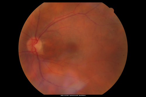 Birdshot Chorioretinitis - Retinal Vasculitis - HLA A29 Positive 
64-year-old woman three or four yearâ€™s fluctuations in her vision.  She mostly notices them in bright light her vision glares out and she has difficulty seeing. PMHx: malaria in 1948 that was treated.  She was told at one point she could possibly have had Familial Mediterranean fever. 

She does intermittently get rashes around her arms.  She has arthritis in her knees and ankles.  
VISUAL ACUITY:  OD 20/40,  OS 20/50 -  HLA - A29 Positive
