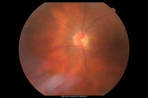 Birdshot Chorioretinitis - Retinal Vasculitis - HLA A29 Positive 
64-year-old woman three or four yearâ€™s fluctuations in her vision.  She mostly notices them in bright light her vision glares out and she has difficulty seeing. PMHx: malaria in 1948 that was treated.  She was told at one point she could possibly have had Familial Mediterranean fever. 

She does intermittently get rashes around her arms.  She has arthritis in her knees and ankles.  
VISUAL ACUITY:  OD 20/40,  OS 20/50 -  HLA - A29 Positive
