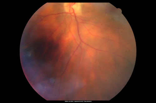 Birdshot Chorioretinitis - Retinal Vasculitis - HLA A29 Positive 
64-year-old woman three or four yearâ€™s fluctuations in her vision.  She mostly notices them in bright light her vision glares out and she has difficulty seeing. PMHx: malaria in 1948 that was treated.  She was told at one point she could possibly have had Familial Mediterranean fever. 

She does intermittently get rashes around her arms.  She has arthritis in her knees and ankles.  
VISUAL ACUITY:  OD 20/40,  OS 20/50 -  HLA - A29 Positive
