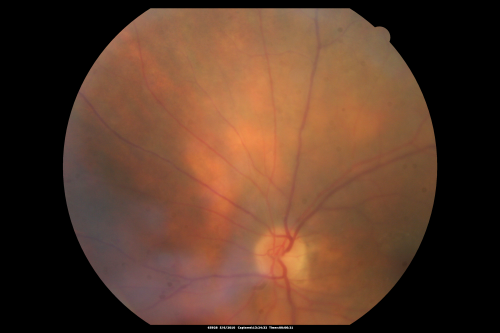 Birdshot Chorioretinitis - Retinal Vasculitis - HLA A29 Positive 
64-year-old woman three or four yearâ€™s fluctuations in her vision.  She mostly notices them in bright light her vision glares out and she has difficulty seeing. PMHx: malaria in 1948 that was treated.  She was told at one point she could possibly have had Familial Mediterranean fever. 

She does intermittently get rashes around her arms.  She has arthritis in her knees and ankles.  
VISUAL ACUITY:  OD 20/40,  OS 20/50 -  HLA - A29 Positive
