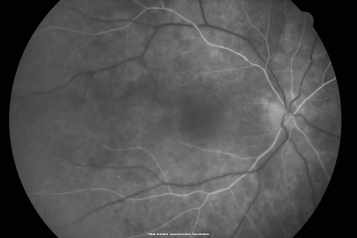 Birdshot Chorioretinitis - Retinal Vasculitis - HLA A29 Positive 
64-year-old woman three or four yearâ€™s fluctuations in her vision.  She mostly notices them in bright light her vision glares out and she has difficulty seeing. PMHx: malaria in 1948 that was treated.  She was told at one point she could possibly have had Familial Mediterranean fever. 

She does intermittently get rashes around her arms.  She has arthritis in her knees and ankles.  
VISUAL ACUITY:  OD 20/40,  OS 20/50 -  HLA - A29 Positive
