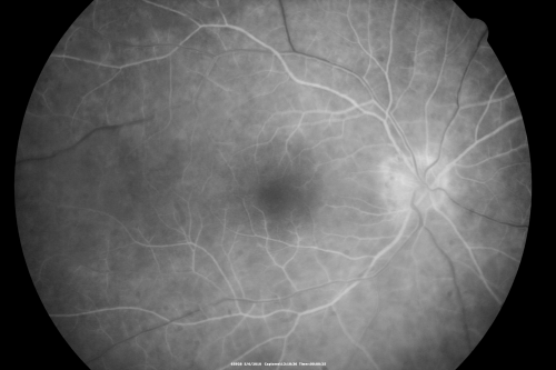 Birdshot Chorioretinitis - Retinal Vasculitis - HLA A29 Positive 
64-year-old woman three or four yearâ€™s fluctuations in her vision.  She mostly notices them in bright light her vision glares out and she has difficulty seeing. PMHx: malaria in 1948 that was treated.  She was told at one point she could possibly have had Familial Mediterranean fever. 

She does intermittently get rashes around her arms.  She has arthritis in her knees and ankles.  
VISUAL ACUITY:  OD 20/40,  OS 20/50 -  HLA - A29 Positive
