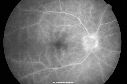 Birdshot Chorioretinitis - Retinal Vasculitis - HLA A29 Positive 
64-year-old woman three or four yearâ€™s fluctuations in her vision.  She mostly notices them in bright light her vision glares out and she has difficulty seeing. PMHx: malaria in 1948 that was treated.  She was told at one point she could possibly have had Familial Mediterranean fever. 

She does intermittently get rashes around her arms.  She has arthritis in her knees and ankles.  
VISUAL ACUITY:  OD 20/40,  OS 20/50 -  HLA - A29 Positive
