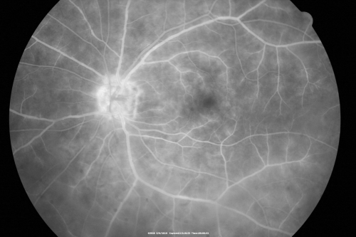 Birdshot Chorioretinitis - Retinal Vasculitis - HLA A29 Positive 
64-year-old woman three or four yearâ€™s fluctuations in her vision.  She mostly notices them in bright light her vision glares out and she has difficulty seeing. PMHx: malaria in 1948 that was treated.  She was told at one point she could possibly have had Familial Mediterranean fever. 

She does intermittently get rashes around her arms.  She has arthritis in her knees and ankles.  
VISUAL ACUITY:  OD 20/40,  OS 20/50 -  HLA - A29 Positive
