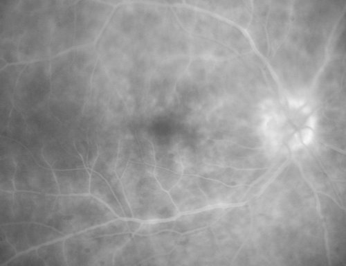 Birdshot Chorioretinitis - Retinal Vasculitis - HLA A29 Positive 
64-year-old woman three or four yearâ€™s fluctuations in her vision.  She mostly notices them in bright light her vision glares out and she has difficulty seeing. PMHx: malaria in 1948 that was treated.  She was told at one point she could possibly have had Familial Mediterranean fever. 

She does intermittently get rashes around her arms.  She has arthritis in her knees and ankles.  
VISUAL ACUITY:  OD 20/40,  OS 20/50 -  HLA - A29 Positive
