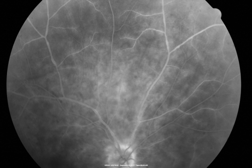 Birdshot Chorioretinitis - Retinal Vasculitis - HLA A29 Positive 
64-year-old woman three or four yearâ€™s fluctuations in her vision.  She mostly notices them in bright light her vision glares out and she has difficulty seeing. PMHx: malaria in 1948 that was treated.  She was told at one point she could possibly have had Familial Mediterranean fever. 

She does intermittently get rashes around her arms.  She has arthritis in her knees and ankles.  
VISUAL ACUITY:  OD 20/40,  OS 20/50 -  HLA - A29 Positive
