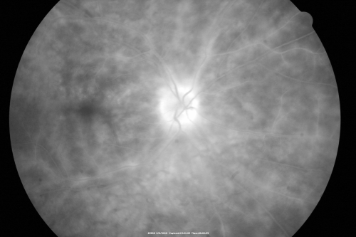Birdshot Chorioretinitis - Retinal Vasculitis - HLA A29 Positive 
64-year-old woman three or four yearâ€™s fluctuations in her vision.  She mostly notices them in bright light her vision glares out and she has difficulty seeing. PMHx: malaria in 1948 that was treated.  She was told at one point she could possibly have had Familial Mediterranean fever. 

She does intermittently get rashes around her arms.  She has arthritis in her knees and ankles.  
VISUAL ACUITY:  OD 20/40,  OS 20/50 -  HLA - A29 Positive
