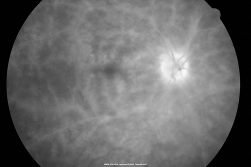 Birdshot Chorioretinitis - Retinal Vasculitis - HLA A29 Positive 
64-year-old woman three or four yearâ€™s fluctuations in her vision.  She mostly notices them in bright light her vision glares out and she has difficulty seeing. PMHx: malaria in 1948 that was treated.  She was told at one point she could possibly have had Familial Mediterranean fever. 

She does intermittently get rashes around her arms.  She has arthritis in her knees and ankles.  
VISUAL ACUITY:  OD 20/40,  OS 20/50 -  HLA - A29 Positive
