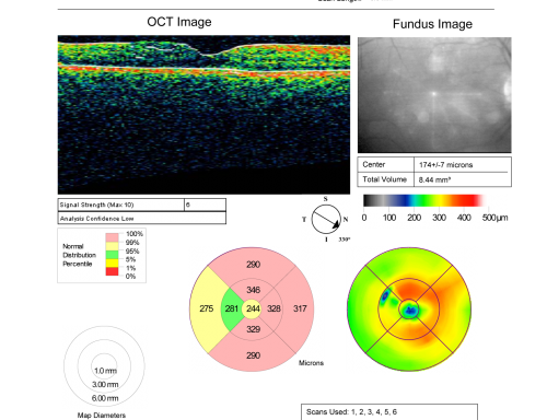 Birdshot Chorioretinitis - Retinal Vasculitis - HLA A29 Positive 
64-year-old woman three or four yearâ€™s fluctuations in her vision.  She mostly notices them in bright light her vision glares out and she has difficulty seeing. PMHx: malaria in 1948 that was treated.  She was told at one point she could possibly have had Familial Mediterranean fever. 

She does intermittently get rashes around her arms.  She has arthritis in her knees and ankles.  
VISUAL ACUITY:  OD 20/40,  OS 20/50 -  HLA - A29 Positive
