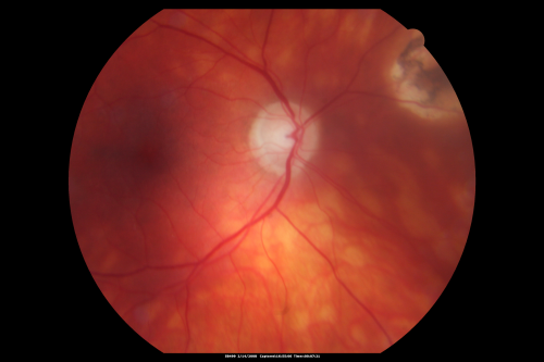 Birdshot Chorioretinitis Mild - Asymptomatic
59-year-old man has birdshot chorioretinopathy in both eyes. Vision OD 20/25, OS 20/20. IOP: OD 16, OS 14. The right eye has a posterior chamber intraocular lens in good position. There is 1+ posterior capsular opacity. The left eye has 2+ nuclear sclerosis.
EXTENDED OPHTHALMOSCOPY:
OD: Vertical C/D ration is 0.8. There is patchy depigmented lesion in the nasal periphery. The retina is attached with peripheral laser.
OS: Vertical C/D ratio is 0.4. There are peripheral punched out lesions in the periphery
Keywords: birdshot chorioretinitis; vitiliginous; white spot