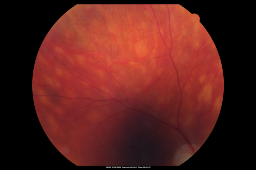 Birdshot Chorioretinitis Mild - Asymptomatic
59-year-old man has birdshot chorioretinopathy in both eyes. Vision OD 20/25, OS 20/20. IOP: OD 16, OS 14. The right eye has a posterior chamber intraocular lens in good position. There is 1+ posterior capsular opacity. The left eye has 2+ nuclear sclerosis.
EXTENDED OPHTHALMOSCOPY:
OD: Vertical C/D ration is 0.8. There is patchy depigmented lesion in the nasal periphery. The retina is attached with peripheral laser.
OS: Vertical C/D ratio is 0.4. There are peripheral punched out lesions in the periphery
Keywords: birdshot chorioretinitis; vitiliginous; white spot