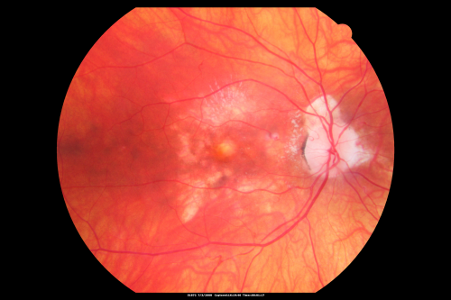 Atypical Birdshot Chorioretinitis and Retinal Arterial Macroaneurysm Right Eye - HLA-B29 Positive
55-year-old woman has multifocal choroiditis in both eyes because she was HLA A-29 positive.  She has presumptive birdshot chorioretinopathy.  She has not noticed any vision changes.  OD 20/40, OS 20/20..
