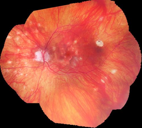 Atypical Birdshot Chorioretinitis and Retinal Arterial Macroaneurysm Right Eye - HLA-B29 Positive
55-year-old woman has multifocal choroiditis in both eyes because she was HLA A-29 positive.  She has presumptive birdshot chorioretinopathy.  She has not noticed any vision changes.  OD 20/40, OS 20/20.
