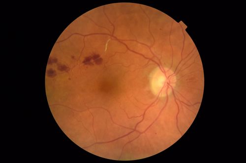 Chronic BRAO with Hemorrhages  - Sclerosed Vessel
95 year old female with blurred vision in both eyes in for a checkup.  History of perpapillary CNVM in the left eye 2 years prior not treated. History of stroke with multiple emboli 1 year ago.
Vision 20/32 OD, 20/40 OS

