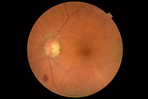 Chronic BRAO with Hemorrhages  - Sclerosed Vessel
95 year old female with blurred vision in both eyes in for a checkup.  History of perpapillary CNVM in the left eye 2 years prior not treated. History of stroke with multiple emboli 1 year ago.
Vision 20/32 OD, 20/40 OS
