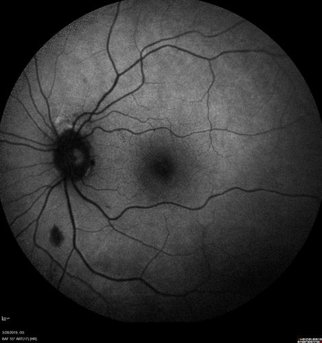 Chronic BRAO with Hemorrhages  - Sclerosed Vessel
95 year old female with blurred vision in both eyes in for a checkup.  History of perpapillary CNVM in the left eye 2 years prior not treated. History of stroke with multiple emboli 1 year ago.
Vision 20/32 OD, 20/40 OS
