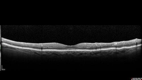 Chronic BRAO with Hemorrhages  - Sclerosed Vessel
95 year old female with blurred vision in both eyes in for a checkup.  History of perpapillary CNVM in the left eye 2 years prior not treated. History of stroke with multiple emboli 1 year ago.
Vision 20/32 OD, 20/40 OS
