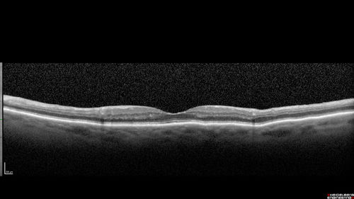 Chronic BRAO with Hemorrhages  - Sclerosed Vessel
95 year old female with blurred vision in both eyes in for a checkup.  History of perpapillary CNVM in the left eye 2 years prior not treated. History of stroke with multiple emboli 1 year ago.
Vision 20/32 OD, 20/40 OS
