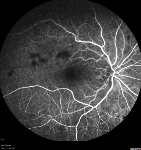 Chronic BRAO with Hemorrhages  - Sclerosed Vessel
95 year old female with blurred vision in both eyes in for a checkup.  History of perpapillary CNVM in the left eye 2 years prior not treated. History of stroke with multiple emboli 1 year ago.
Vision 20/32 OD, 20/40 OS
