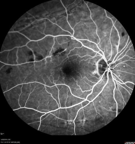 Chronic BRAO with Hemorrhages  - Sclerosed Vessel
95 year old female with blurred vision in both eyes in for a checkup.  History of perpapillary CNVM in the left eye 2 years prior not treated. History of stroke with multiple emboli 1 year ago.
Vision 20/32 OD, 20/40 OS
