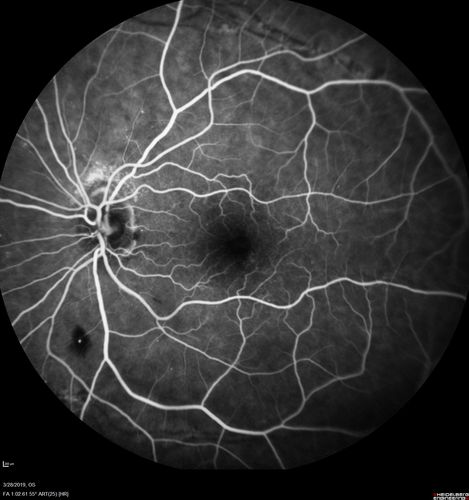 Chronic BRAO with Hemorrhages  - Sclerosed Vessel
95 year old female with blurred vision in both eyes in for a checkup.  History of perpapillary CNVM in the left eye 2 years prior not treated. History of stroke with multiple emboli 1 year ago.
Vision 20/32 OD, 20/40 OS
